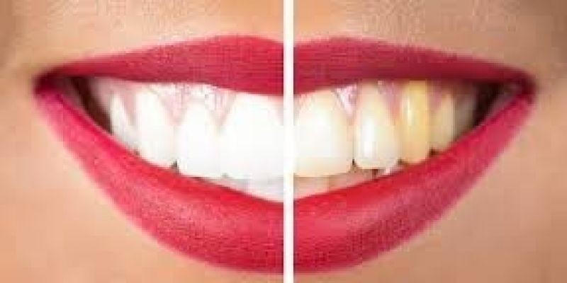 Spa gigi untuk hadirkan gigi putih berkilau