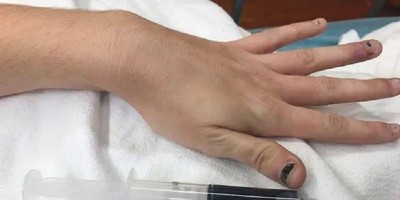 Gara-gara Obat Sakit Gigi, Wanita Ini Memiliki Darah Biru