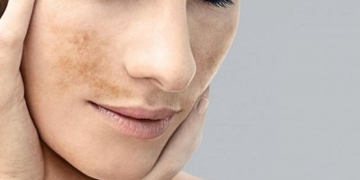 Wanita Usia 40, Waspadai Dark Spot!