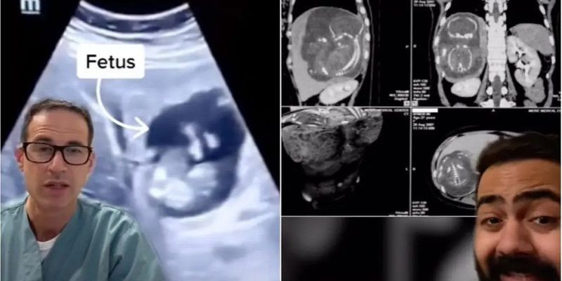 Video viral di TikTok tentang seorang ibu hamil dengan janin di luar rahim/Net
