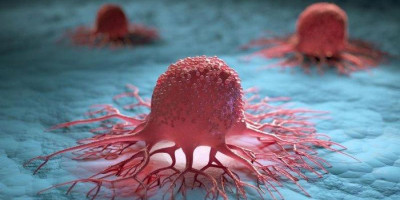 Pertama Kali di Dunia, Uji Klinis Obat Kanker Menunjukkan 'Kanker Hilang' 100 Persen