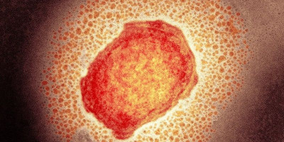 Cacar Monyet Semakin Mengkhawatirkan, Satu Anak Usia Sekolah Dasar di Belanda Positif Terpapar Virus Monkeypox