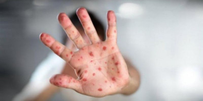 Pemerintah Jakarta Telusuri Kontak Erat Pasien Monkeypox, Pengamat: Hindari Bersalaman dengan Tangan Bersentuhan Langsung