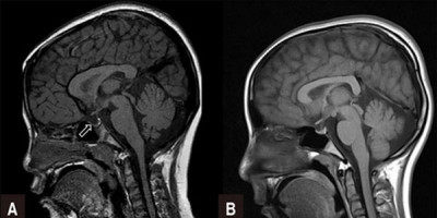 Mengenal Empty Sella Syndrome, Penyakit Langka yang Diderita Ruben Onsu
