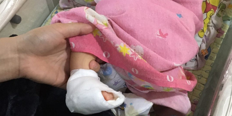 Kaki bayi asal Medan, Sumatera Utara terpaksa diperban usai dugaan terjadinya malpraktik