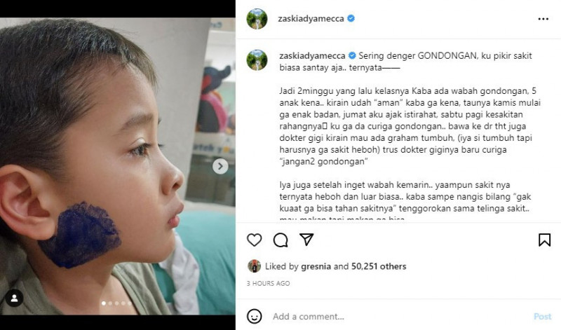 Zaskia Adya Mecca memposting kondisi anaknya yang sedang sakit gondongan di akun Instagram pribadinya/Tangkapan Layar