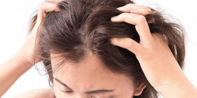 Bahaya Kerak Rambut Bukan Sekadar Ketombe, Ketahui Penyebabnya