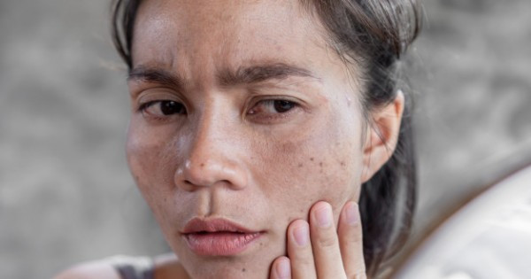 Iritasi pada wajah akibat pemakaian skin care palsu/Net