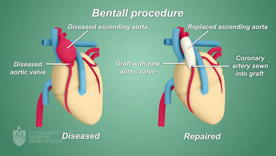 Prosedur Bentall, operasi yang seharusnya dijalani pasien II pada tiga tahun lalu/Net