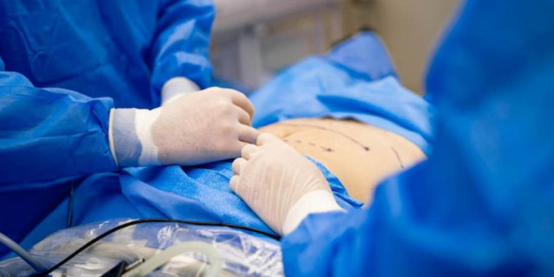Ilustrasi bedah caesar.  Alat bedah silinder ditemukan pada perut perempuan Selandia Baru/NET 