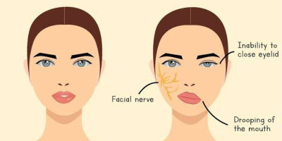 Sering Terkena Paparan Angin Bisa Sebabkan Bell’s Palsy, Benarkah?