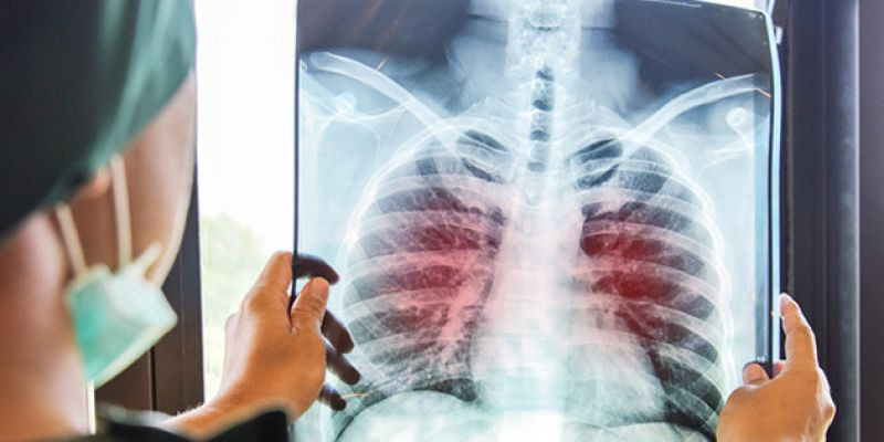 Ilustrasi paru-paru dengan infeksi tuberkulosis/Freepik