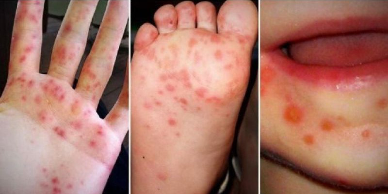 Telapak tangan, kaki, dan mulut anak yang terinfeksi flu Singapura/UMSU