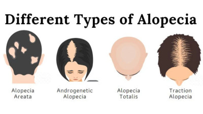 Alopecia yang Dialami Jada Pinkett Smith dan Agnes Monica, Bisakah Disembuhkan?